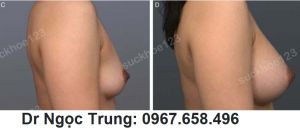 Nâng ngực đặt túi gel Mentor 275 cc, nữ 38 tuổi - ca 4