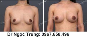 Nâng ngực đặt túi gel Mentor 275 cc, nữ 38 tuổi - ca 4