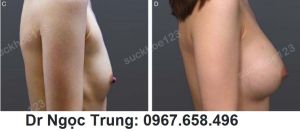 Nâng ngực đặt túi gel Mentor size 335 cc, nữ 26 tuổi - ca 5