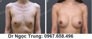 Nâng ngực đặt túi gel Mentor size 335 cc, nữ 26 tuổi - ca 5