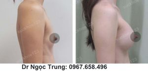 Nâng ngực bằng túi gel size 300 cc - ca 6