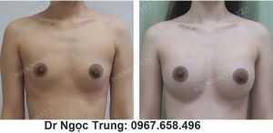 Nâng ngực bằng túi gel size 300 cc - ca 6