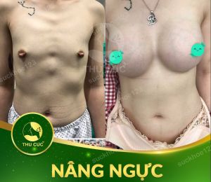 Nâng ngực thẩm mỹ Thu Cúc - ca 1