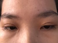 Mí mắt bị ngắn sau khi cắt