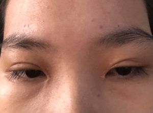 Mí mắt bị ngắn sau khi cắt