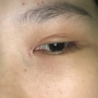 Cắt mí bị ngắn