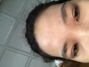 Mí mắt bị ngắn sau khi cắt