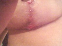 Tôi có 2 vết thương hở và tôi đang bôi vaseline mỗi ngày hoặc thuốc mỡ ba lần mỗi ngày, tôi nên làm gì nữa?