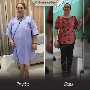 Phẫu thuật giảm cân, nữ 45 tuổi, 98 kg - ca 2