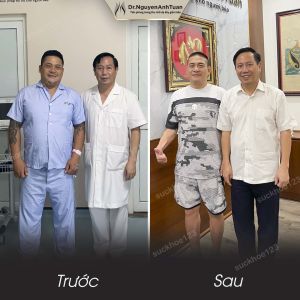 Phẫu thuật giảm cân, nam 48 tuổi, 93 kg - ca 3