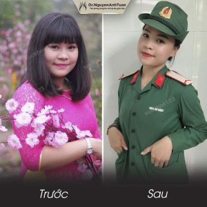 Phẫu thuật giảm cân, nữ 26 tuổi, 78 kg - ca 4