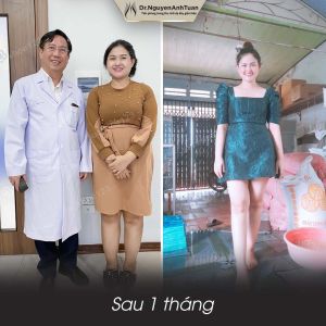 Phẫu thuật giảm cân, nữ 28 tuổi, 78 kg - ca 7