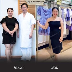 Phẫu thuật giảm cân, nữ 35 tuổi, 86 kg - ca 8
