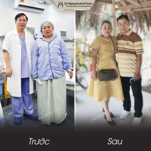 Phẫu thuật giảm cân, nữ 40 tuổi, 88 kg - ca 9