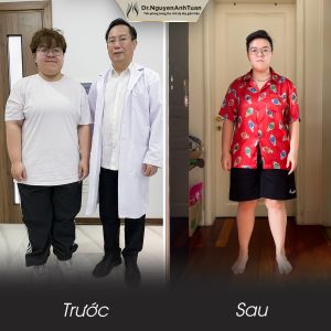 Phẫu thuật giảm cân, nam 22 tuổi, 91 kg - ca 10