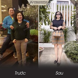 Phẫu thuật giảm cân, nữ 45 tuổi, 82 kg - ca 11