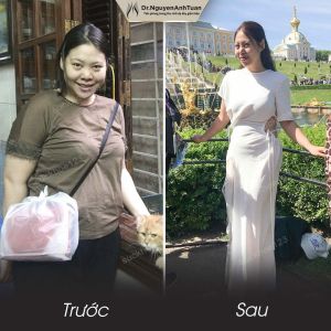 Phẫu thuật giảm cân, nữ 28 tuổi, 93 kg - ca 12