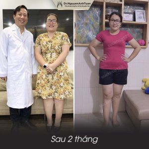 Phẫu thuật giảm cân, nữ 32 tuổi, 88 kg - ca 13