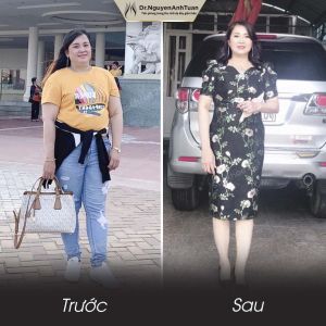 Phẫu thuật giảm cân, nữ 33 tuổi, 90kg - ca 14