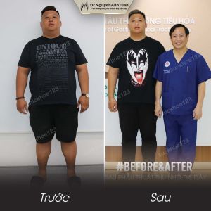 Phẫu thuật giảm cân, nam 28 tuổi, 163 kg - ca 15