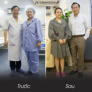 Phẫu thuật giảm cân, nữ 35 tuổi, 80 kg - ca 16