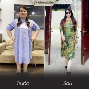 Phẫu thuật giảm cân, nữ 42 tuổi, 82 kg - ca 17