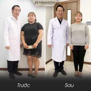 Phẫu thuật giảm cân, nữ 27 tuổi, 95 kg - ca 19