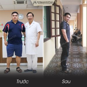 Phẫu thuật giảm cân, nam 38 tuổi, 87 kg - ca 20
