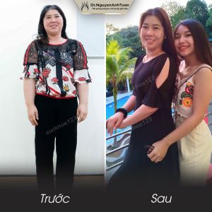 Phẫu thuật giảm cân, nữ 45 tuổi, 88 kg - ca 21