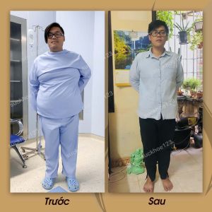 Phẫu thuật giảm cân, nam 27 tuổi, 109 kg - ca 23