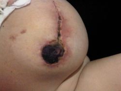 Một trong những núm vú của tôi đã chuyển sang màu đen hoàn toàn sau khi làm thu nhỏ vú, tôi nên làm gì?