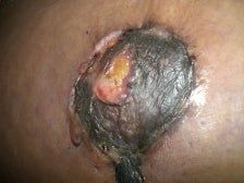 Phải chăng núm vú của tôi đã chết sau khi làm thu nhỏ ngực?