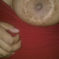 Làm thế nào để làm mờ vết sẹo xấu xí sau thu nhỏ quầng vú? Làm thế nào để làm mờ vết sẹo xấu xí sau thu nhỏ quầng vú?