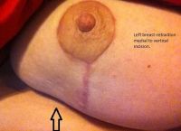 Phẫu thuật từ 9 tuần trước, gặp khá nhiều vấn đề hậu phẫu, có bình thường không?