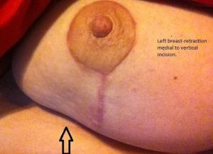 Phẫu thuật từ 9 tuần trước, gặp khá nhiều vấn đề hậu phẫu, có bình thường không?