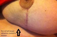 Phẫu thuật từ 9 tuần trước, gặp khá nhiều vấn đề hậu phẫu, có bình thường không?