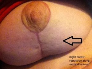 Phẫu thuật từ 9 tuần trước, gặp khá nhiều vấn đề hậu phẫu, có bình thường không?