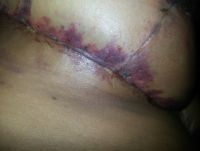 Chăm sóc vết mổ sau khi thu nhỏ ngực?