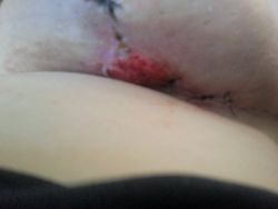 Vết thương hở chảy máu sau treo sa trễ/thu nhỏ ngực?