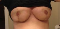 Có phải vết mổ thu nhỏ ngực của tôi đã bị khâu quá chặt?