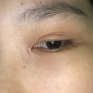 Mí mắt bị ngắn sau khi cắt