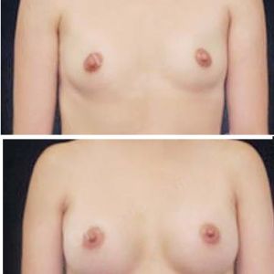 Nâng ngực Dr Ngọc Trung - ca 20