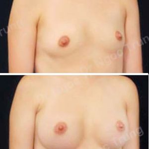 Nâng ngực Dr Ngọc Trung - ca 20