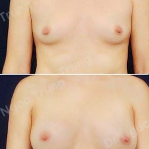 Nâng ngực Dr Ngọc Trung - ca 21