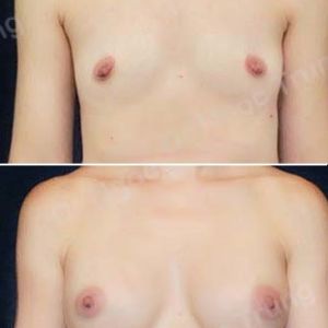 Nâng ngực Dr Ngọc Trung - ca 25