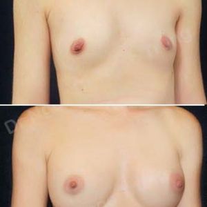 Nâng ngực Dr Ngọc Trung - ca 25