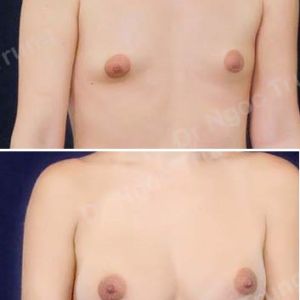 Nâng ngực Dr Ngọc Trung - ca 26