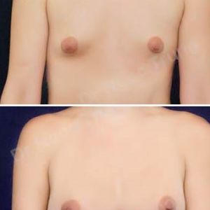 Nâng ngực Dr Ngọc Trung - ca 26