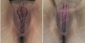 Cắt môi bé, nữ 25 tuổi DHT Clinic - ca 13