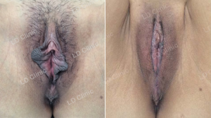 Cắt môi bé, nữ 45 tuổi DHT Clinic - ca 15